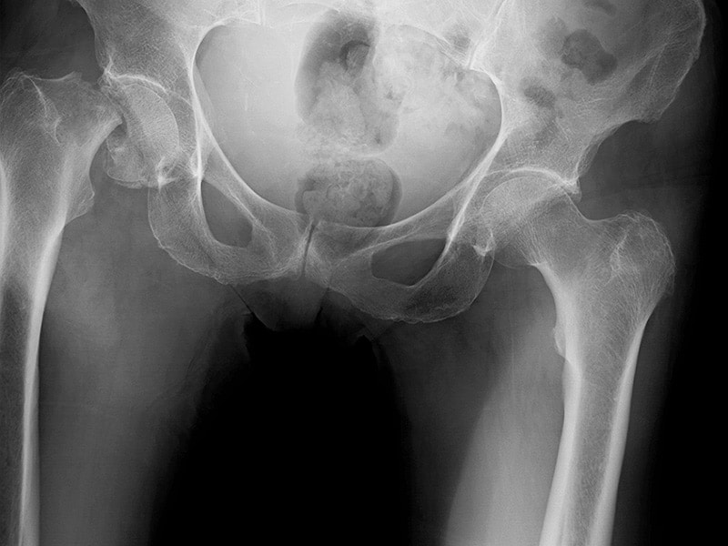 Death Rates Rise For Hip Fracture Patients Discharged Early