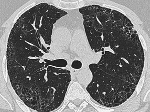 Benefit of Antifibrotics in Pulmonary Fibrosis Debated