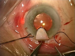 Microstent Keeps Intraocular Pressure Low