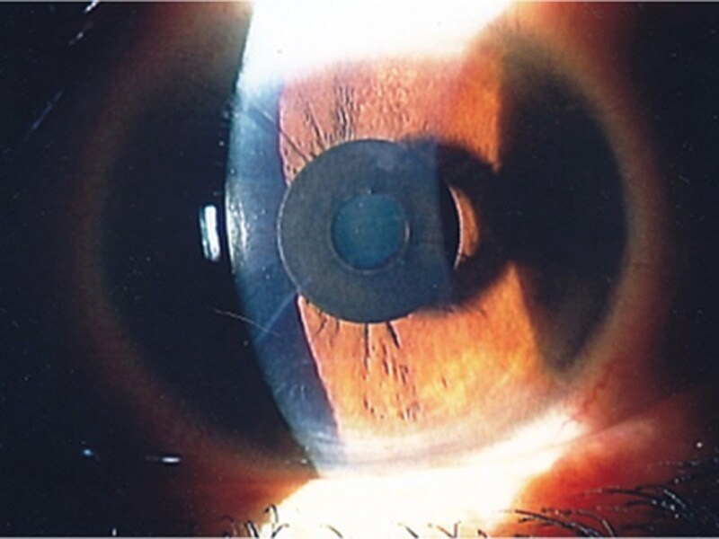 FDA OKs First Near Vision Fix That Needs No Cataract Surgery