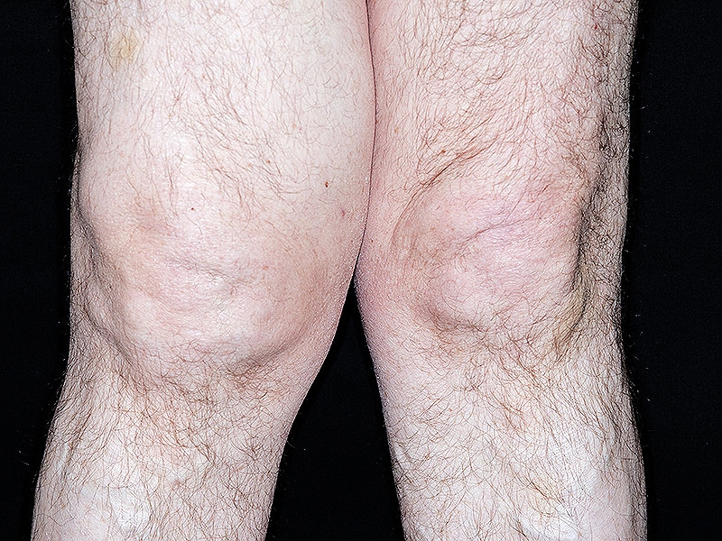 Chondroitin-Glucosamine Reduced Pain in Knee Arthritis in RCT