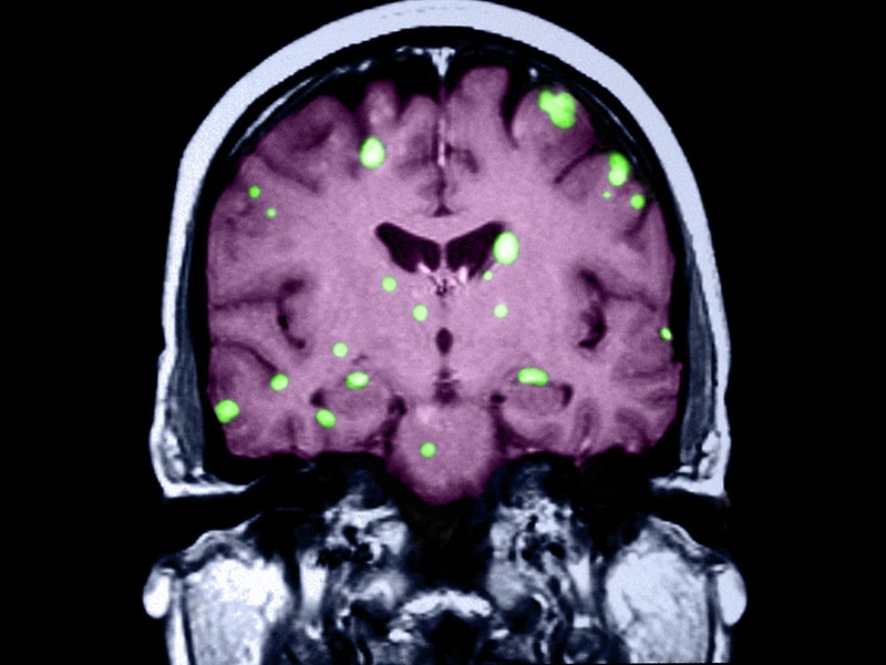 'Sun Is Setting' on WholeBrain Radiation for Mets