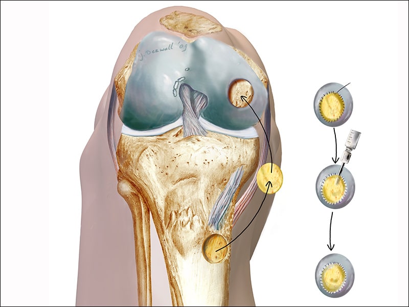 Chondrocyte Therapy Effective in Knee Cartilage Repair