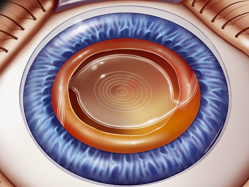 intraocular lens treatment