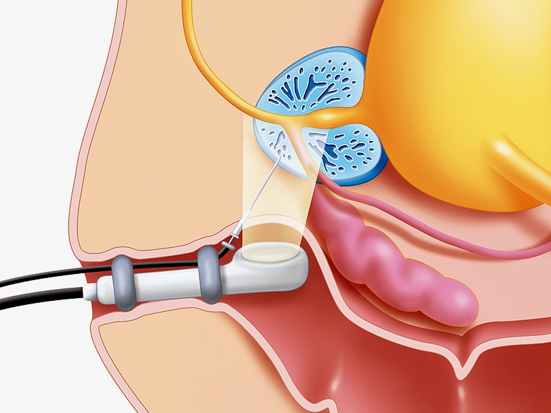 Transperineal Prostate Biopsy Well Tolerated Study Shows