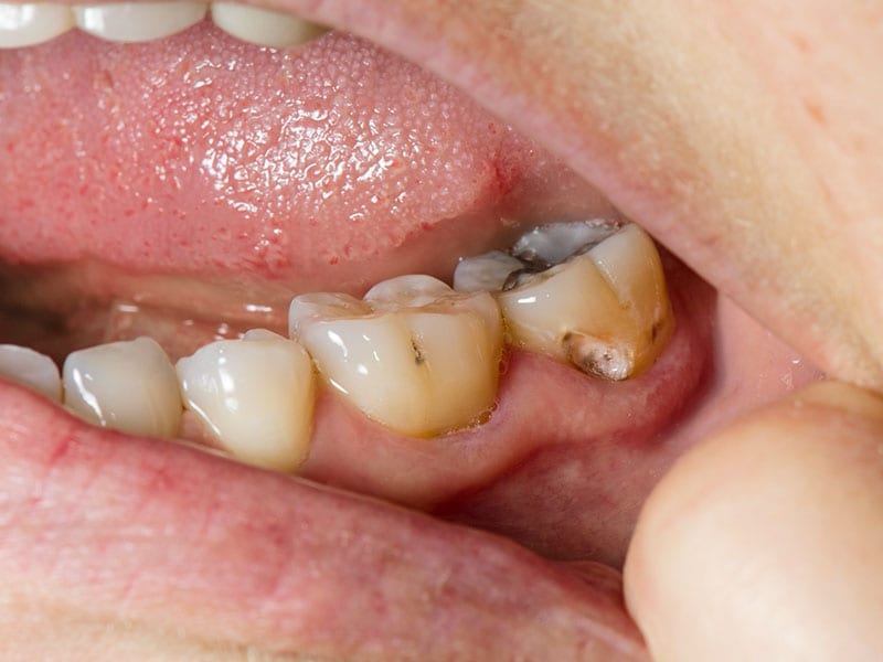 untreated-tooth-decay-common-in-us-adults-cdc-says