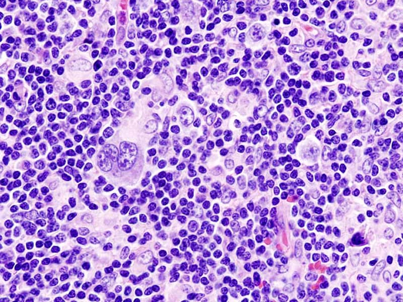 New ILROG Guidelines for Pediatric Hodgkin's Lymphoma