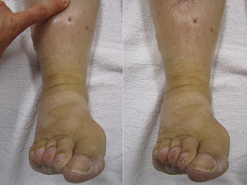 what-is-edema-6-types-symptoms-and-causes-2024