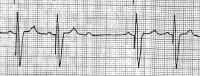 Pacemaker Malfunction Clinical Presentation: History, Physical, Causes