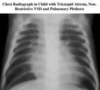 Tricuspid Atresia Workup: Laboratory Studies, Imaging Studies, Other Tests