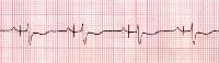 Pacemaker Malfunction Clinical Presentation: History, Physical, Causes