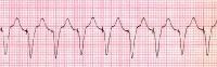 Pacemaker Malfunction Clinical Presentation: History, Physical, Causes