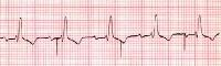 Pacemaker Malfunction Clinical Presentation: History, Physical, Causes