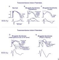 Dr. Smith's ECG Blog: Brugada pattern induced by tricyclic