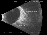 B-Scan Ocular Ultrasound: Overview, Indications for Examination ...