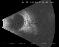 B-Scan Ocular Ultrasound: Overview, Indications for Examination ...