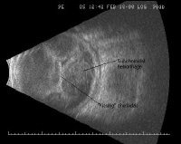 B-Scan Ocular Ultrasound: Overview, Indications for Examination ...