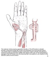 Tendon Transfers: History, Concepts, Timing of Tendon Transfer