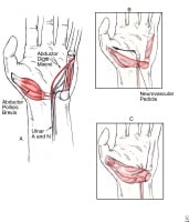 Tendon Transfers: History, Concepts, Timing of Tendon Transfer