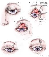 Upper Eyelid Reconstruction Procedures Treatment & Management: Surgical ...