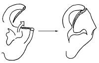 Ear Reconstruction and Salvage Procedures Treatment & Management