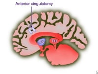 Neuromodulation Surgery for Psychiatric Disorders