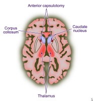 Neuromodulation Surgery for Psychiatric Disorders