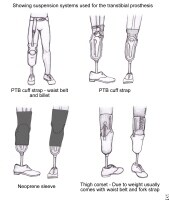 Amputations of the Lower Extremity