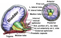 Transurethral Resection of the Prostate