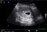 Ultrasonographic Imaging in the Diagnosis of Ectopic Pregnancy ...