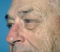 Principles and Techniques of Nasal Reconstruction: Overview ...