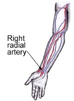 Arterial Blood Gas Sampling