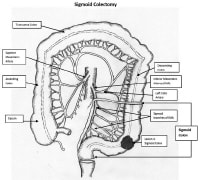 Open Left Colectomy: Overview, Relevant Anatomy, Indications