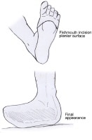 Transmetatarsal Amputation