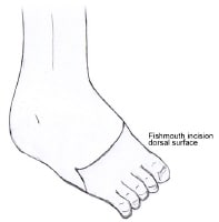 Transmetatarsal Amputation