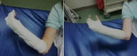 Short-Arm Splinting