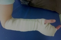 Short-Arm Splinting