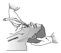 Laryngeal Mask Airway: Overview, Indications, Contraindications