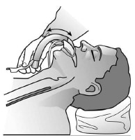 Laryngeal Mask Airway: Overview, Indications, Contraindications