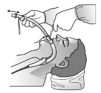 Laryngeal Mask Airway: Overview, Indications, Contraindications