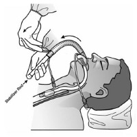 Laryngeal Mask Airway: Overview, Indications, Contraindications