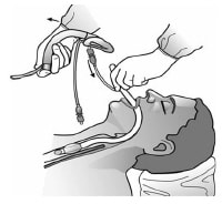 Laryngeal Mask Airway: Overview, Indications, Contraindications