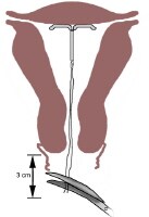 Intrauterine Device Insertion: Overview, Periprocedural Care, Technique