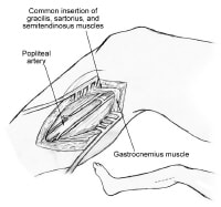 Infrapopliteal Bypass