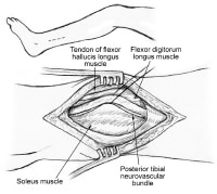 Infrapopliteal Bypass