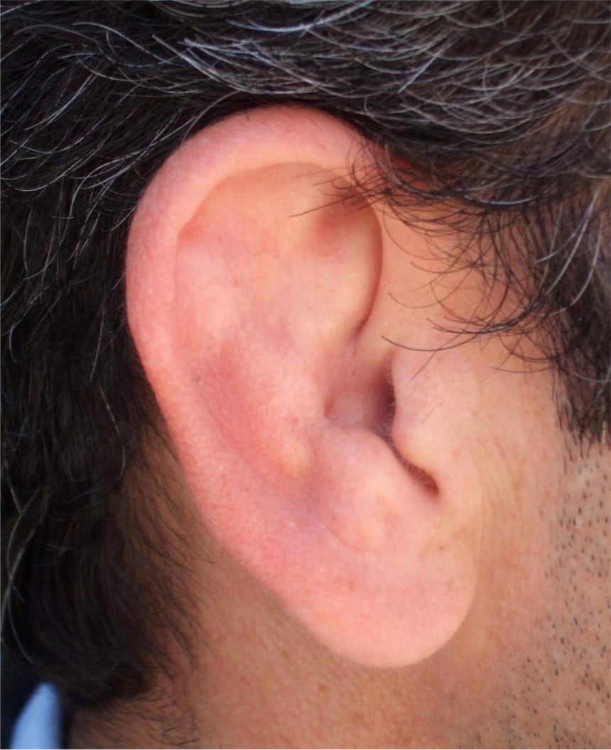 Cauliflower Ear Surgery. 