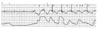 Transcutaneous Cardiac Pacing Technique