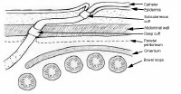 Peritoneal Dialysis Catheter Insertion