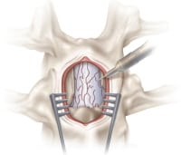 Selective Dorsal Rhizotomy for Spasticity Technique