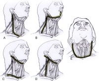 Cervical Lymphadenectomy: Overview, Periprocedural Care, Technique